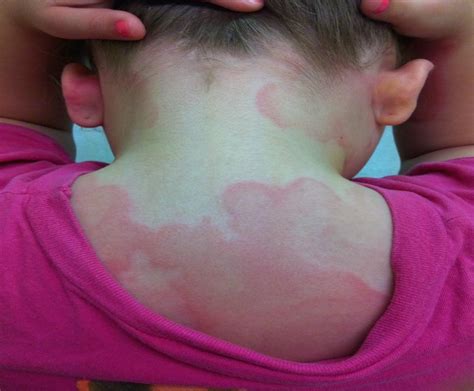 Urticaria Multiforme