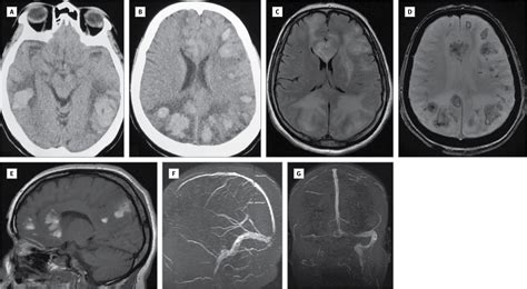 Weil Syndrome A Rare Cause Of Cerebral Venous Thrombosis