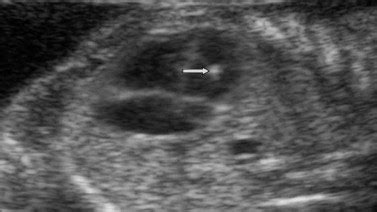 Four-chamber view of the heart showing a single echogenic intracardiac ...