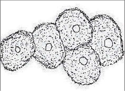 Clue cell - Indian Journal of Dermatology, Venereology and Leprology