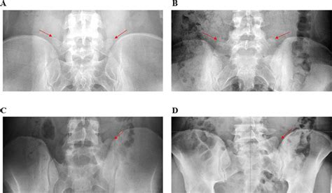 Radiographic Classification of Lumbosacral Transitional Vertebrae ...