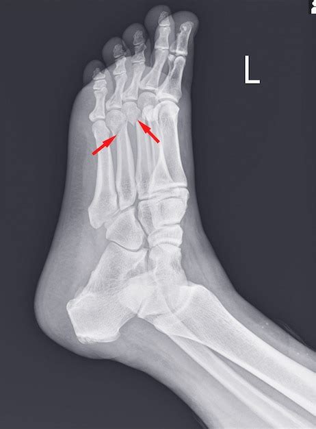 Radiografia Do Pé E Tornozelo Mostrando Fraturas Do Metatarso Foto Premium