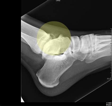 Anterior Ankle Impingement | Dominic Carreira, MD | Hip Arthroscopy ...