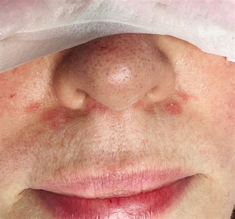 Perioral Dermatitis Face