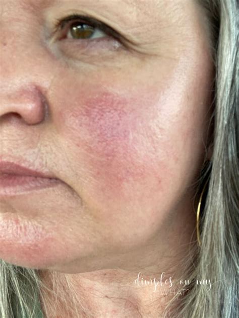 Laser Treatment For Rosacea Near Me