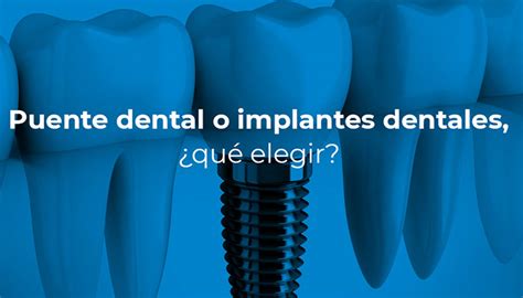 Puente Dental O Implantes Dentales Qu Elegir Ccm Dental