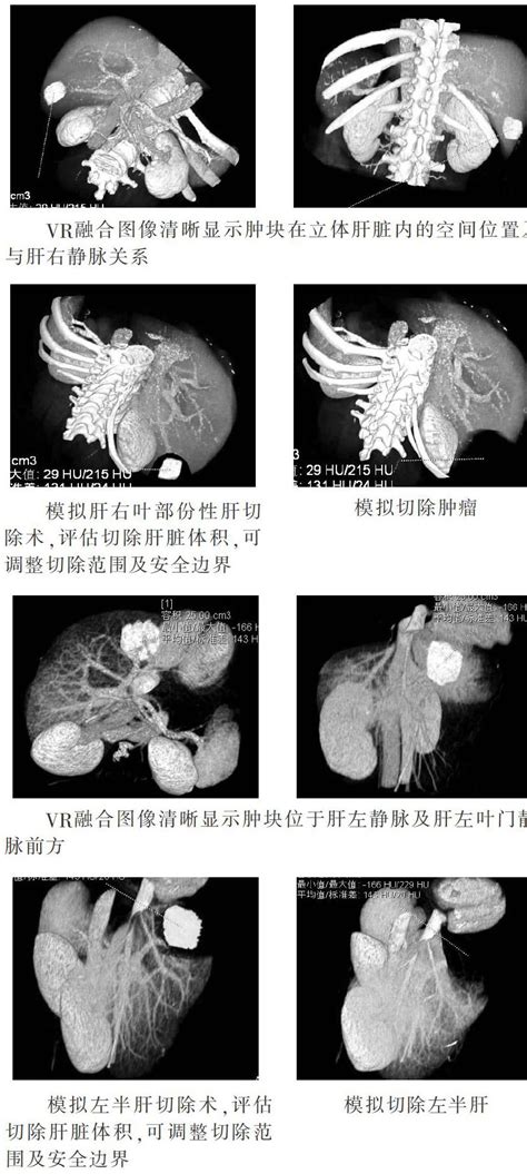 128层螺旋ct Vr图像融合重建技术在肝精确切除术前评估的应用 参考网