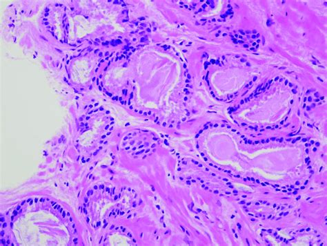 B High Power View Of Adenocarcinoma H And E Download Scientific