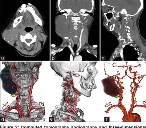 Figure 2 From Extracranial Internal Carotid Artery Aneurysm