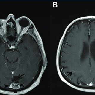 A Axial Post Contrast T1 Weighted Images Show Heterogeneous