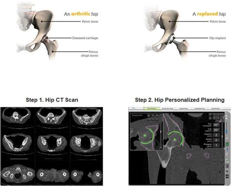 Mako Robotic Arm Assisted Technology For Total Hip Replacement South Bend In Hip Surgeon