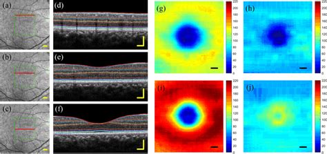 D Segmentation Result Of A Healthy Retina And The Thickness Maps Of