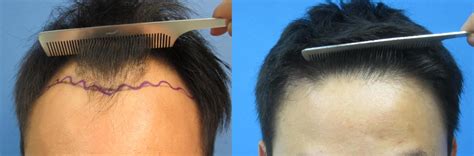 FUE Hair Transplant Los Angeles | Dr. Sean Behnam