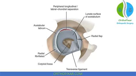 Acetabular Labral Tear Orthofixar 2025