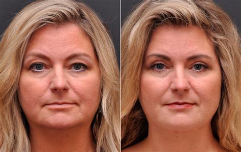 Eye Rejuvenation Brow Lift Vs Blepharoplasty