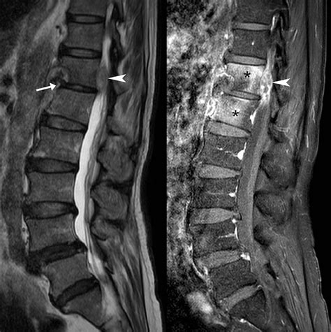 T2 Weighted A And T1 Weighted Post Contrast B Sagittal Lumbar