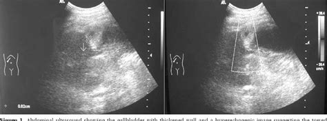 Figure 1 From Diagnosis And Laparoscopic Approach To Gallbladder