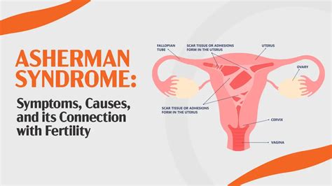 Asherman Syndrome Symptoms Causes And Its Connection With Fertility