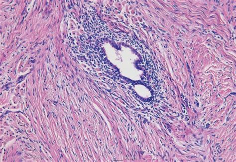 Histopathologic Findings With H E Benign Endometrial Gland And Stroma