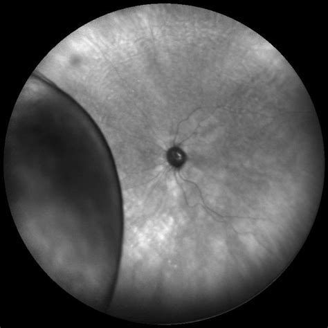 Retinal Detachment Highland Retina Associates Terre Haute Indiana