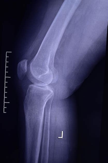 Arthrose De L Articulation Du Genou Radiographie Photo Premium