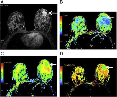 Diffusion Tensor Imaging In The Normal Breast Influences Of