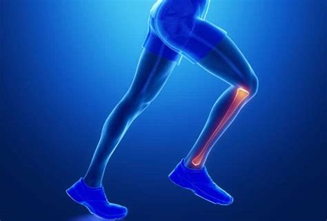 Periostitis tibial al correr causas síntomas y tramtamiento