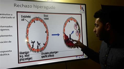 Fisiopatolog A Del Rechazo En Trasplante De Rganos Youtube