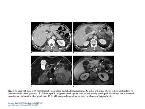 Fig Year Old Male With Pathologically Confirmed Ductal Adenocarcinoma