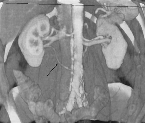 Three Dimensional Volume Rendered Ct Angiography Of The Renal Arteries