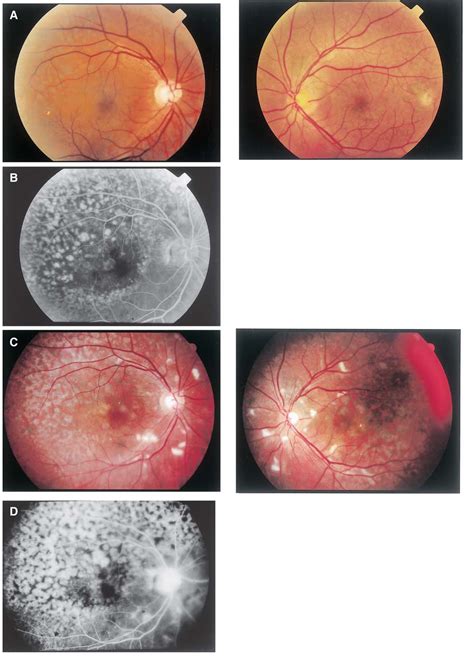 Figure From Coloration Of Fundus Lesions In Bilateral Diffuse Uveal