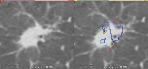 Lung Fused CT Pathology Featured The Cancer Imaging Archive TCIA