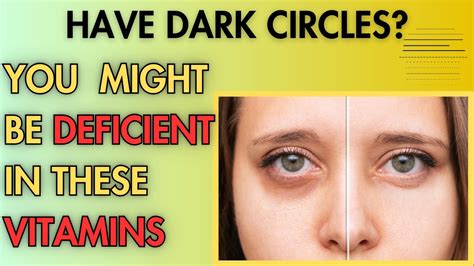 6 Vitamin Deficiency Causing Under Eye Dark Circles Dark Circles Treatment Youtube