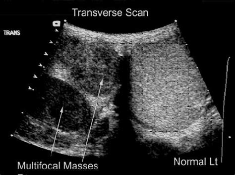 Abnormal Testicular Ultrasound