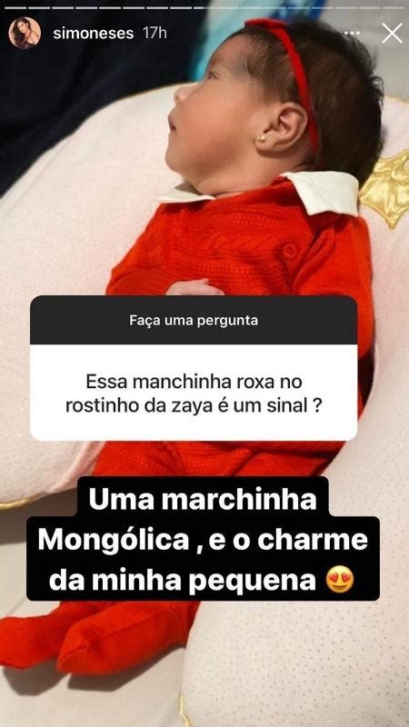 Simone Explica O Que A Manchinha Roxa No Rosto Da Filha Rec M Nascida