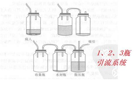 胸腔闭式引流，这些你全掌握了吗？