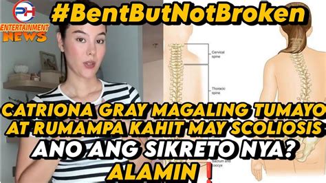 CATRIONA GRAY NADIAGNOSE NA MAY SCOLIOSIS NOONG 12 YEARS PA LANG SIYA