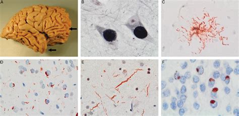 The Neuropathology Underlying Clinical FTD Is Variable There Is