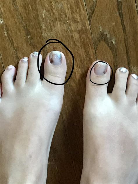 Possible Melanoma Under Toenail Rmelanoma