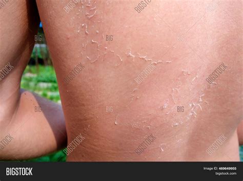 Man Received Sunburn Image And Photo Free Trial Bigstock