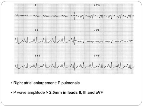 P wave (ECG) - Dr. Akif Baig | PPTX