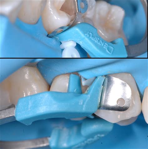 The Importance Of The Contact Point In Class II Restorations