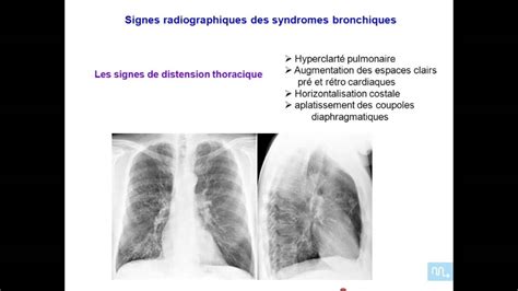 Les Grandes Syndromes Pulmonaires Partie 6 Youtube