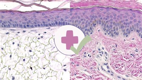 Epithelial Cell Abnormality: Causes Symptoms and Treatment