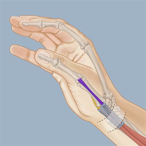 De Quervain Syndrome Treatment