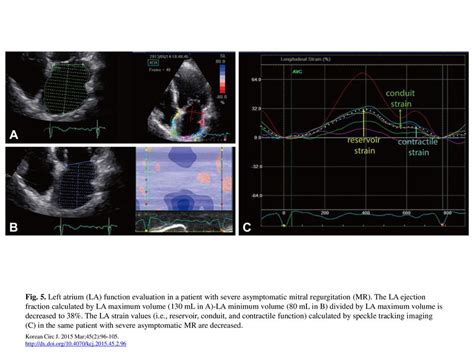 Fig 5 Left Atrium LA Function Evaluation In A Patient With Severe