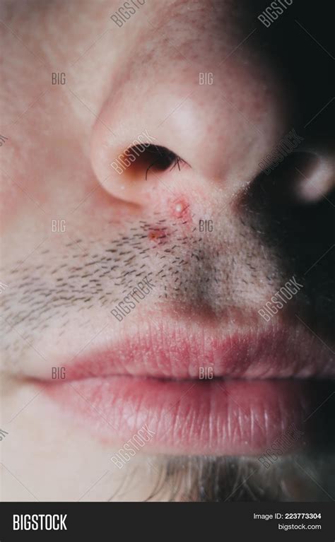 Lump On Nose