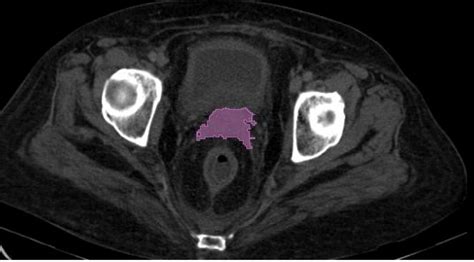 Brachytherapy in Cervical Cancer: Accuracy in Point Dose Demarcation ...