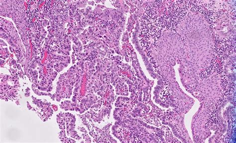 Pathology Outlines Small Cell Carcinoma 42 Off