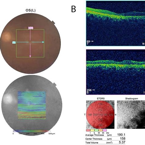 Fundus Photograph And Oct Images Of The Proband A Colour Fundus